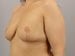 Breast Reduction Patient 04 - After Thumbnail 