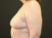 Breast Reduction Patient 05 - After Thumbnail 
