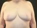 Breast Reduction Patient 05 - After Thumbnail 