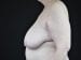 Breast Reduction Patient 05 - Before Thumbnail 