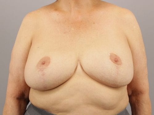 Breast Revision Patient 11 - After Thumbnail