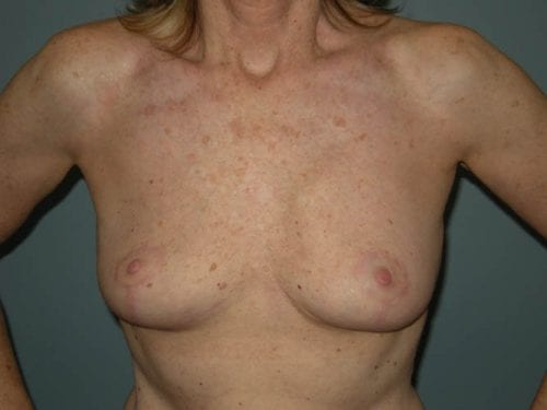 Breast Revision Patient 01 - After Thumbnail