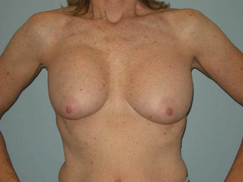 Breast Revision Patient 01 - Before Thumbnail