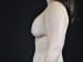 Breast Revision Patient 03 - Before Thumbnail 