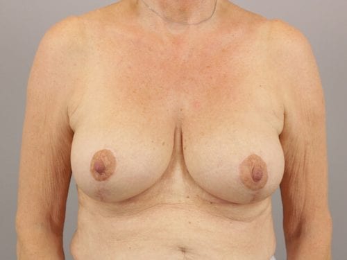 Breast Revision Patient 07 - After Thumbnail