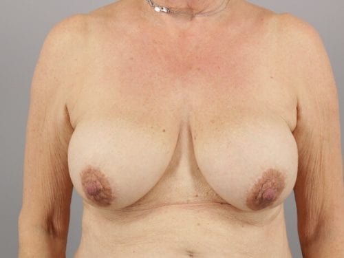 Breast Revision Patient 07 - Before Thumbnail