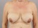 Breast Revision Patient 07 - Before Thumbnail 