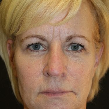 Brow Lift Patient 02 - After 