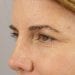 Brow Lift Patient 03 - After Thumbnail 