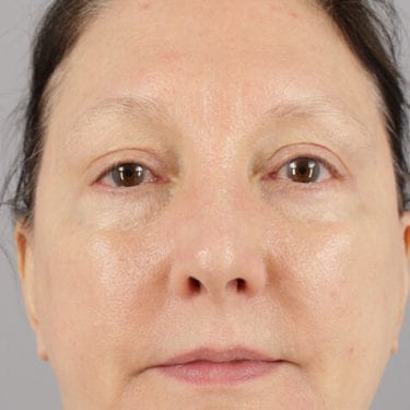 Brow Lift Patient 04 - After 