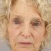 Brow Lift Patient 05 - After Thumbnail 