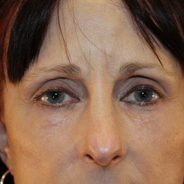 Brow Lift Patient 06 - After 