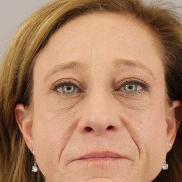 Brow Lift Patient 07 - After 