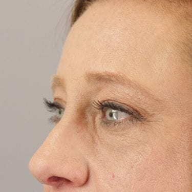 Brow Lift Patient 07 - After 