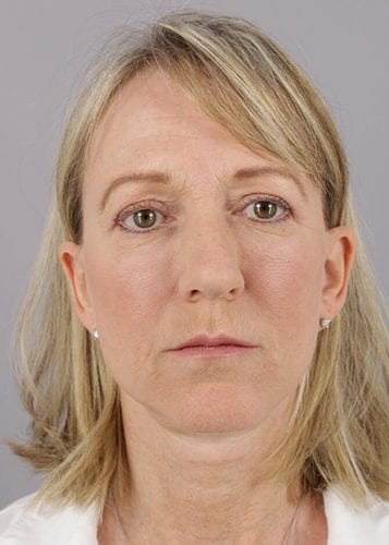 Face Lift Patient 10 - After Thumbnail