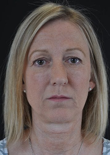 Face Lift Patient 10 - Before Thumbnail