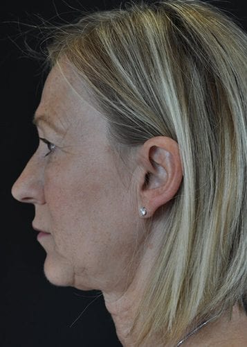 Face Lift Patient 10 - Before 