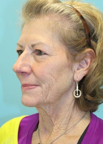 Face Lift Patient 05 - Before 