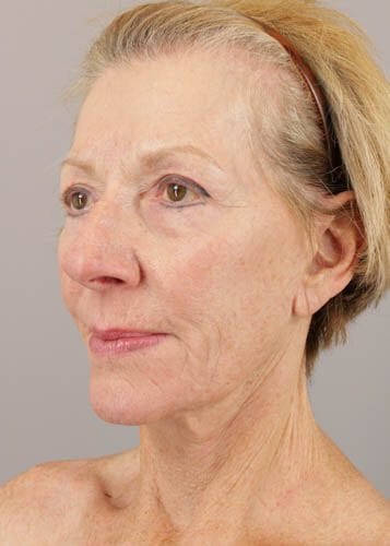 Face Lift Patient 05 - After 