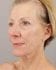 Face Lift Patient 05 - After Thumbnail 