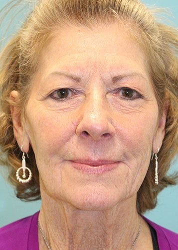 Face Lift Patient 05 - Before Thumbnail