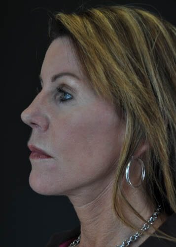 Face Lift Patient 07 - After Thumbnail