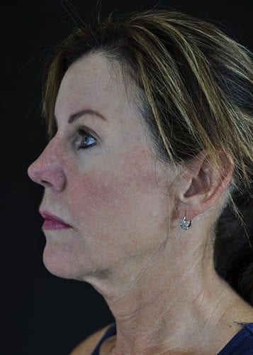 Face Lift Patient 07 - Before Thumbnail