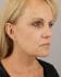 Face Lift Patient 08 - After Thumbnail 