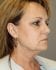 Face Lift Patient 08 - Before Thumbnail 