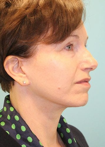 Face Lift Patient 15 - After Thumbnail