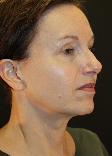 Face Lift Patient 15 - Before Thumbnail