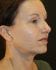 Face Lift Patient 15 - Before Thumbnail 