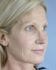 Face Lift Patient 17 - Before Thumbnail 