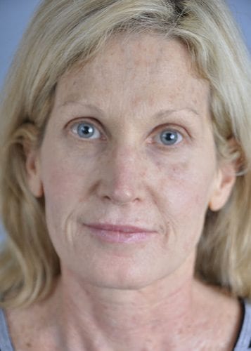 Face Lift Patient 17 - Before 