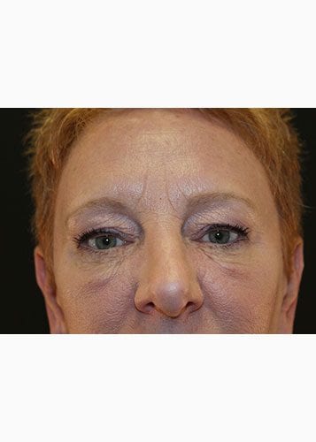 Face Lift Patient 18 - After 2