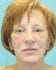 Face Lift Patient 18 - Before Thumbnail 