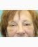 Face Lift Patient 18 - Before Thumbnail 