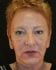 Face Lift Patient 18 - After Thumbnail 