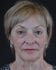 Face Lift Patient 19 - Before Thumbnail 