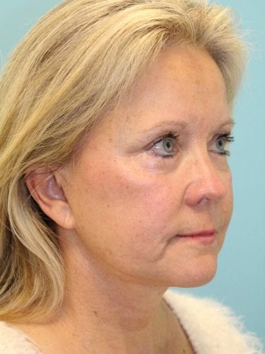 Face Lift Patient 20 - After 