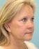 Face Lift Patient 20 - After Thumbnail 