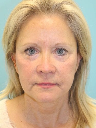 Face Lift Patient 20 - After 