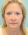 Face Lift Patient 20 - After Thumbnail 