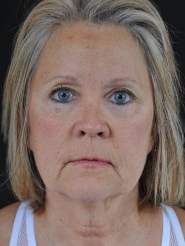 Face Lift Patient 20 - Before 