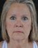 Face Lift Patient 20 - Before Thumbnail 