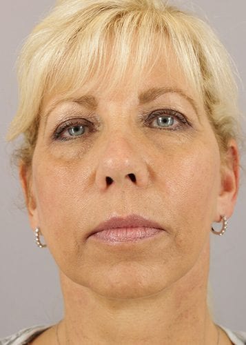 Face Lift Patient 21 - After Thumbnail