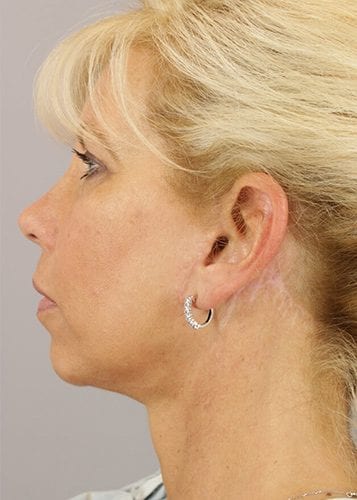Face Lift Patient 21 - After 