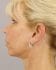 Face Lift Patient 21 - After Thumbnail 