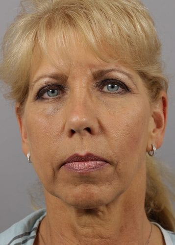 Face Lift Patient 21 - Before Thumbnail