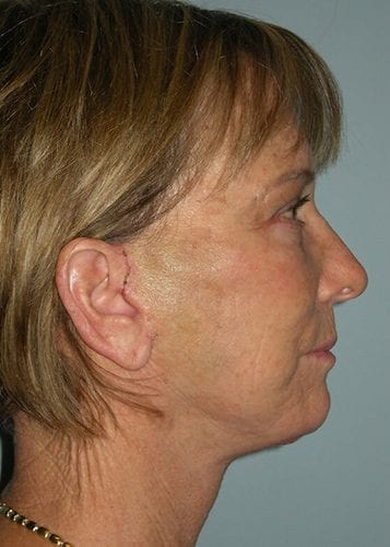 Face Lift Patient 22 - After 